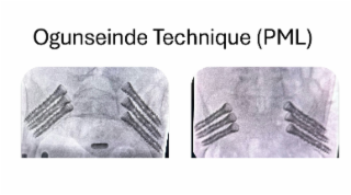 ogunseinde technique (pml)